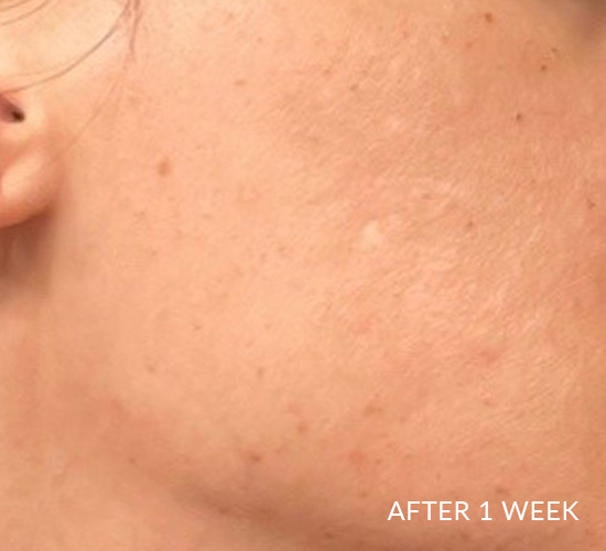 Blemished skin is clear of acne after using Pevonia's ProCorrective Clear-Control system for one week