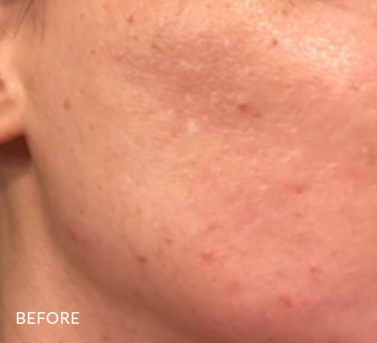 Blemished skin with acne before using Pevonia's ProCorrective Clear-Control solution